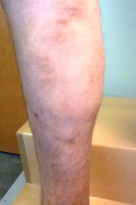 Close-up of a hairy male lower leg with some skin discoloration standing on wooden stairs indoors.