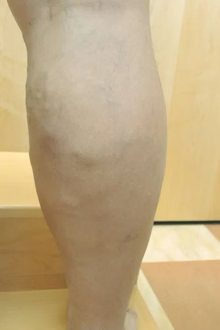 Close-up of a lower leg showing varicose veins and skin texture in a clinical setting with a door in the background