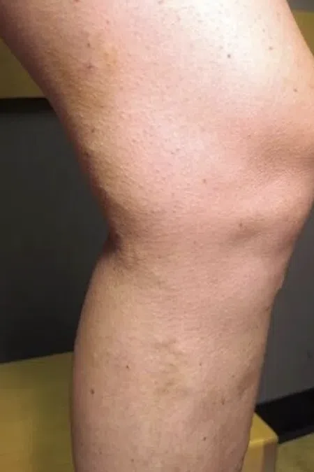 Close-up of a swollen human knee showing skin texture and inflammation on a bent leg.