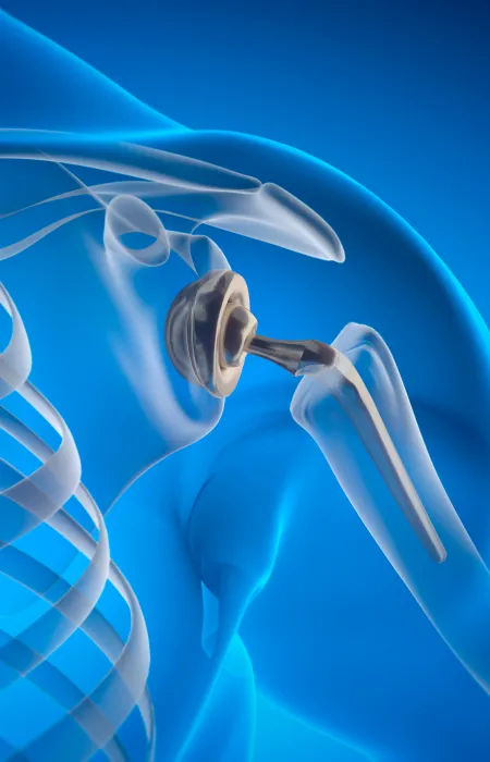 3D illustration of shoulder joint showing metal prosthesis implant replacing the ball and socket joint.