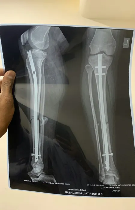 X-ray image showing a leg with surgical metal rod and screws for bone fracture fixation.