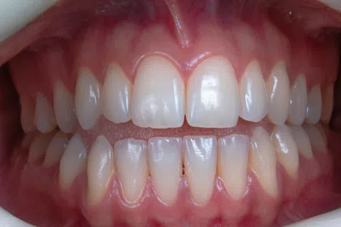 Close-up of healthy human teeth and gums with natural alignment and pink gums.