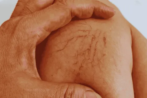 Red spider veins on a person's leg held gently by a hand, highlighting visible varicose veins.
