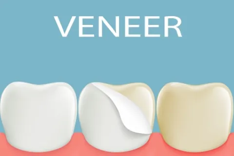 TOOTH SENSITIVITY AFTER VENEERS