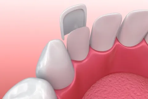 WHEN TO HAVE YOUR VENEERS REPLACED