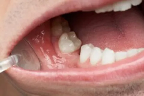 THE IMPORTANCE OF REPLACING MISSING TEETH