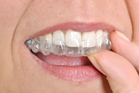 ADJUSTING TO LIFE WITH INVISALIGN