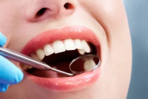 SPOTLIGHT ON COMPOSITE FILLINGS