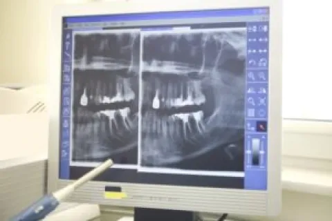 SPOTLIGHT ON THE BENEFITS OF ROOT CANALS