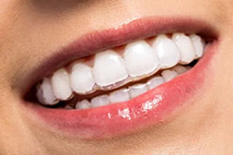 Is Invisalign Right For You?