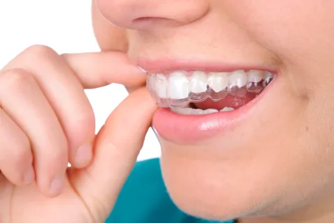 Close-up of a person inserting clear aligners in their mouth, focusing on dental care.