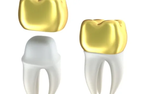 3D rendering of a gold dental crown and a tooth model, highlighting dental restoration components.