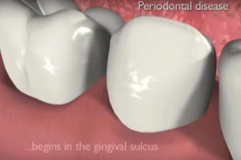 3D illustration showing teeth and gums affected by periodontal disease.
