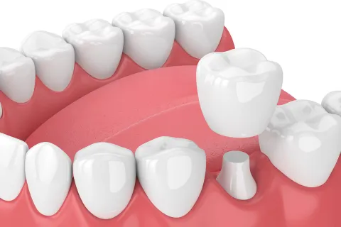3D illustration of teeth structure with dental crown and gum detail.