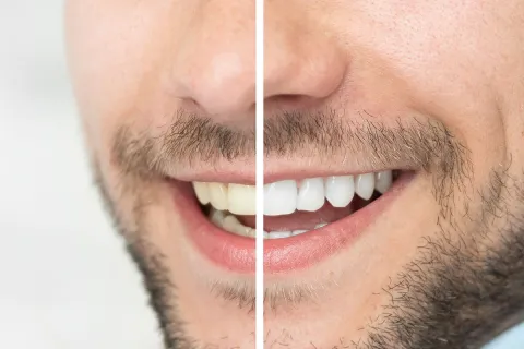 Close-up of a man's smile showing before and after teeth whitening results.