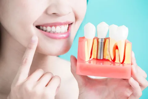 Smiling woman holding a dental implant model with healthy white teeth and gums.