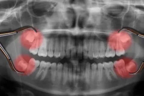 Dental X-ray showing impacted wisdom teeth highlighted in red with dental tools in view.