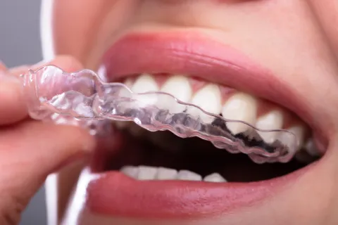 Person wearing clear orthodontic aligners, focusing on teeth and smile details.