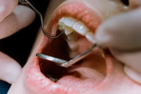 Close-up of a dental examination with tools inspecting teeth and gums inside an open mouth.