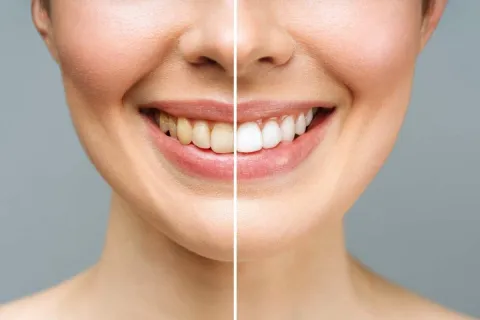 Before-and-after teeth whitening comparison showcasing improved smile brightness.
