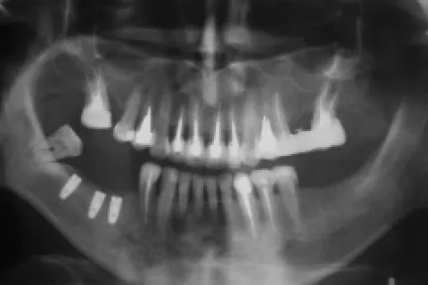 Dental X-ray image showing teeth and jaw structure clearly and in detail.