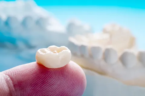 Close-up of a dental crown placed on a finger, showcasing its detail and craftsmanship against a blurred dental model.