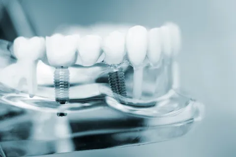 Close-up of dental implants displayed on a transparent model of teeth.