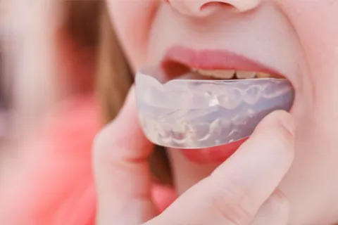 Person inserting a clear dental night guard over their upper teeth for protection and teeth grinding prevention.
