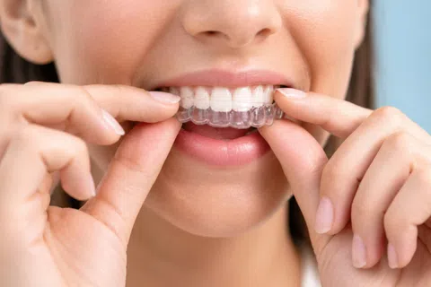 5 Ways to Get the Most Out of Your ClearCorrect Aligners