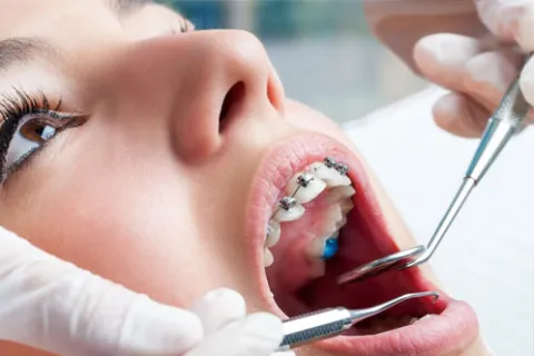 Close-up of a dental examination with braces and dental tools in a patient's open mouth.
