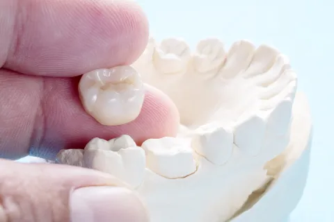 A hand holding a dental crown above a model of teeth, illustrating dental restoration.