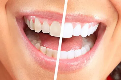 Turn Back Time This Fall With Professional Whitening [Blog]