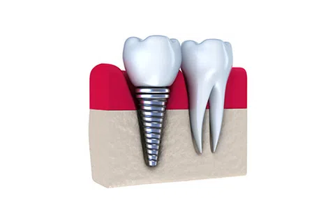 Dental Implants at Martins Dental Partners
