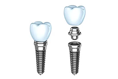 The Benefits of Dental Implants