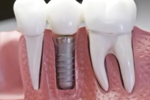 A LOOK AT THE BENEFITS OF DENTAL IMPLANTS