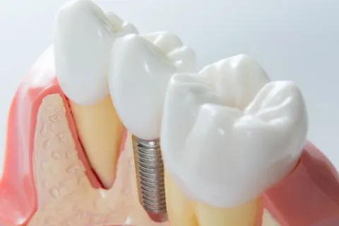 Do You Have a Failing Dental Implant?