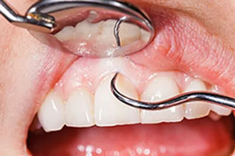Don't Ignore These Signs Of Periodontal Disease
