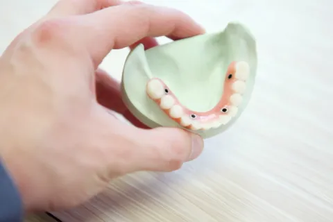 What are Dental Caps?
