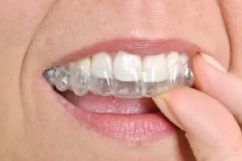 SIGNS THAT YOUR SMILE COULD BENEFIT FROM INVISALIGN