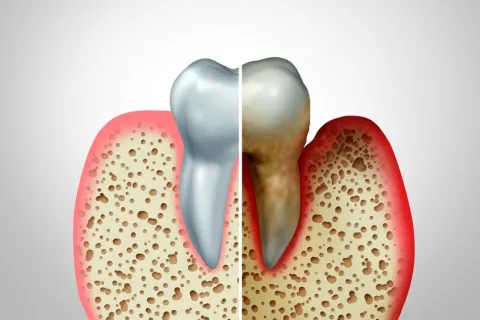 What You Need to Know About Periodontal Disease