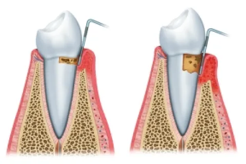 UNDERSTANDING THE STAGES OF GUM DISEASE