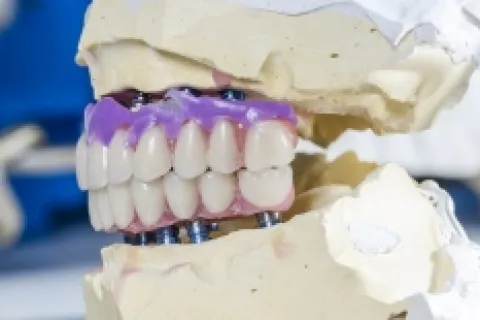 Could You Benefit From Porcelain Inlays?