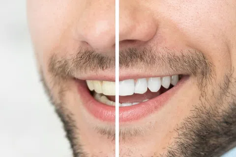 Reasons and Remedies for Tooth Discoloration