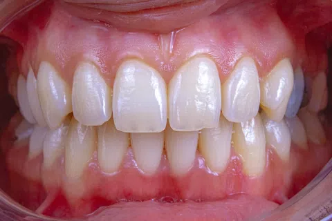 Close-up of healthy upper and lower human teeth and gums showing natural alignment and texture.