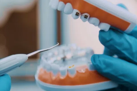 Dental model with braces and dental tools held by a person wearing blue gloves in a clinical setting