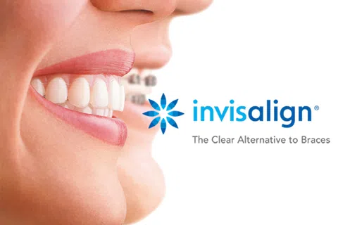 Close-up of smiling faces showing clear Invisalign aligners and traditional metal braces side by side.