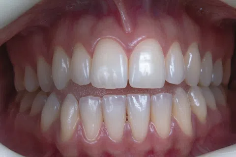 Close-up of human teeth showing dental alignment, healthy gums, and natural tooth color.