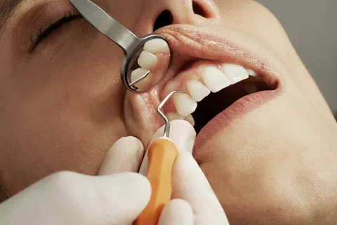 Close-up of upper front teeth with a swollen gum abscess above two teeth and dental gloved fingers.