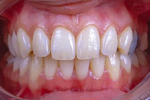 Close-up of human teeth showing slight misalignment and healthy gums with natural shine and texture.