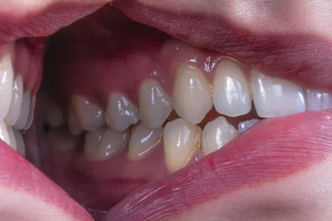 Close-up of a human mouth showing teeth with dental crowding and misalignment.